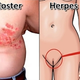 Illustration for article titled cara mengatasi penyakit herpes secara alami ampuh tanpa efek sampingem/em